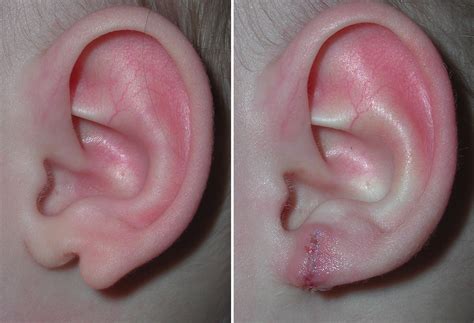Cleft Ear