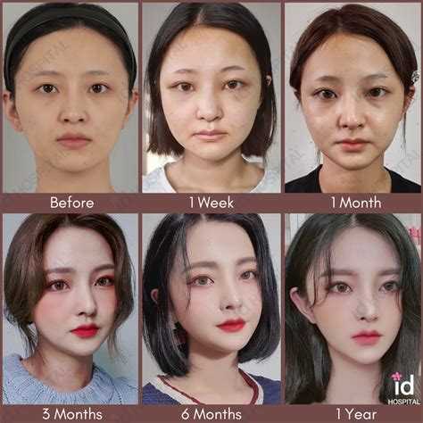 ID Hospital Plastic surgery transformation | Korean plastic surgery, Plastic surgery, Face surgery