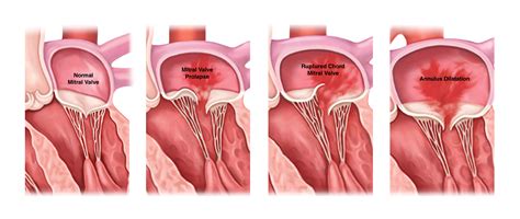 Mitral Valve Regurgitation Treatment | Keyhole Heart Clinic