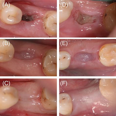 Normal Healing After Tooth Extraction