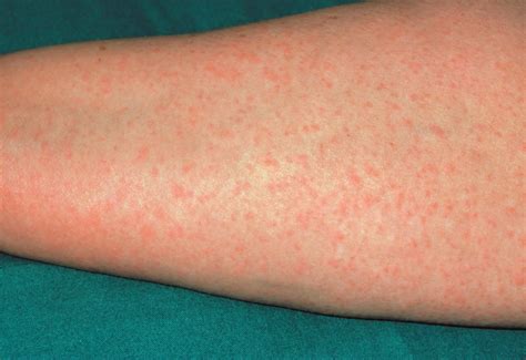 Antibiotic Cellulitis Penicillin Allergy at Christopher Bryant blog