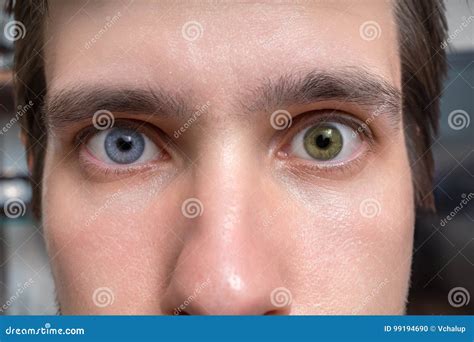 Mismatched Eye Color