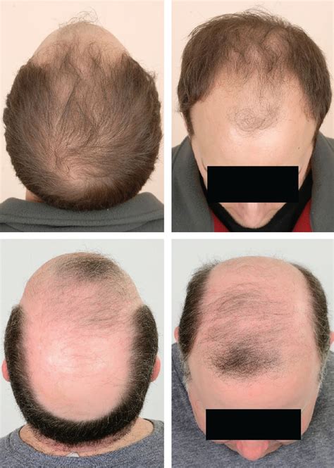 Male Pattern Baldness: Causes, Stages & Treatment Options