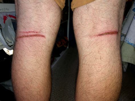 Does this count? 2nd degree friction burn on the back of both my knees ...