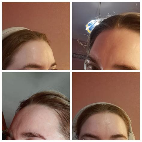 Does this look like en coup de sabre? : r/scleroderma