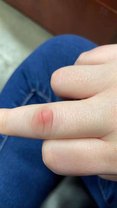 21F Bump On Finger Joint, Anyone Know What This Could Be? (More context in the comments) : r ...