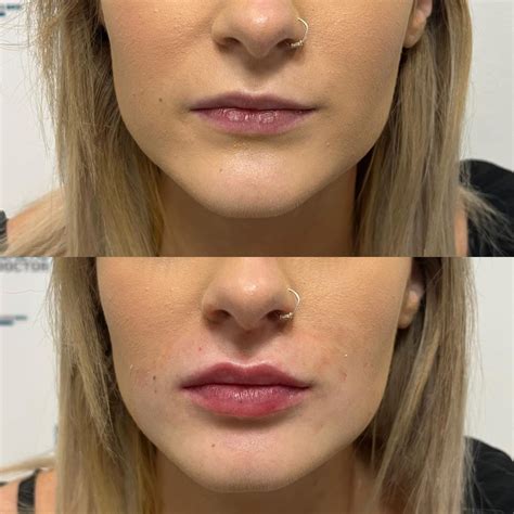 Lip filler 1ml | Lip fillers, Lip fillers juvederm, Facial fillers