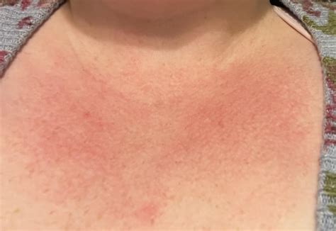 Itchy Rash On Upper Chest Have Had This Red Rash For Several Years.