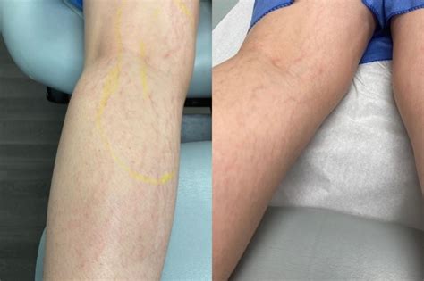 Machine For Stretch Marks at Kelvin Brown blog