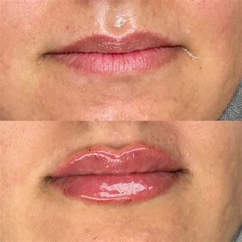 Lip Filler in Lakewood Ranch FL - Natural Results | Serving Bradenton ...