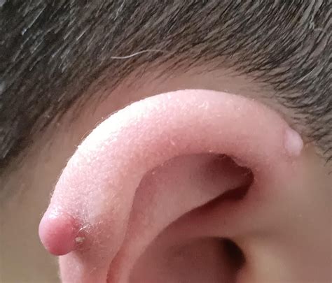 keloid or irritation bump? : r/piercing