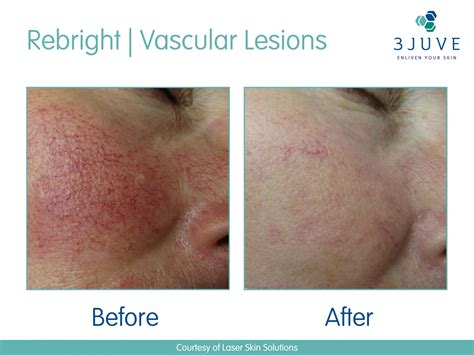 Rosacea Treatment · Laser Clinic