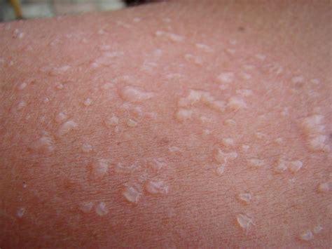 Worst Sunburn Blisters How To Prevent Sunburn Scars – Tiege Hanley