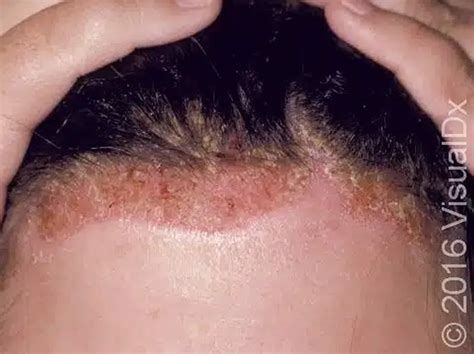 Seborrhoeic Dermatitis Pronunciation