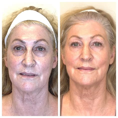 Skin Resurfacing Before and After Gallery | Dr. Connie Hiers Plastic ...