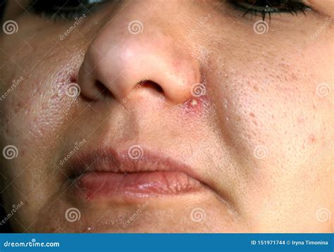 Inflamed Pimple On Nose. Cyst Acne. Acne On The Skin Royalty-Free Stock ...