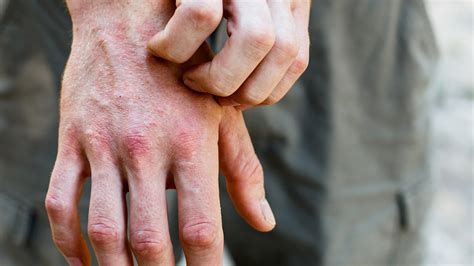 What Causes Eczema to Flare Up? Causes & Triggers | Gladskin