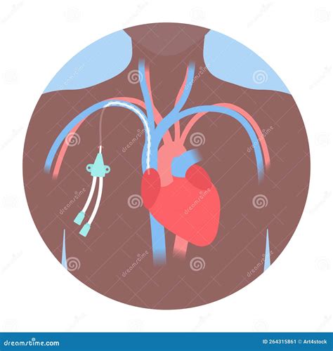 Tunneled Central Line Venous Catheter Medical Diagram Stock Vector ...