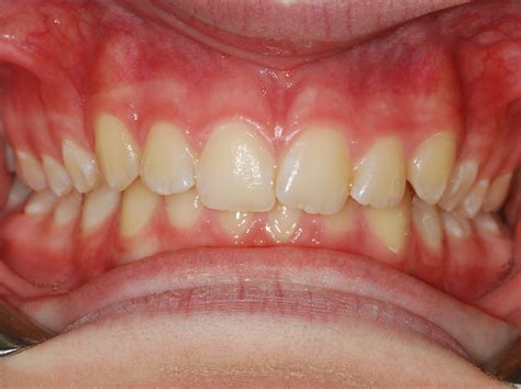 What Can A Human Jaw Bite Through at Dara Patao blog