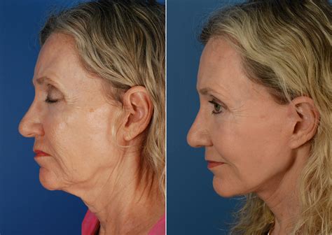 Best Plastic Surgeon For Lower Face Lift at Ha Overton blog
