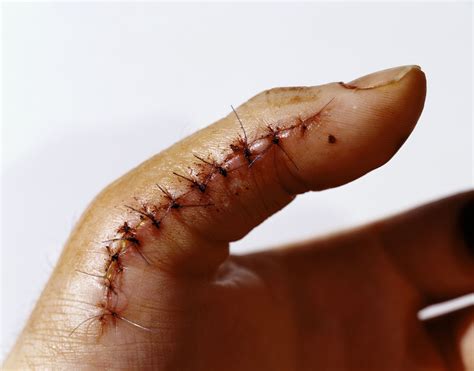 How to Tell if a Wound Needs Stitches