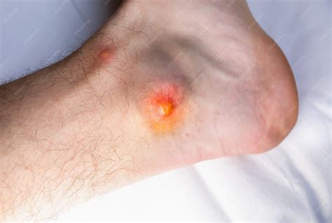 Premium Photo | Insect bite on the foot. mosquito problems. itching wound.