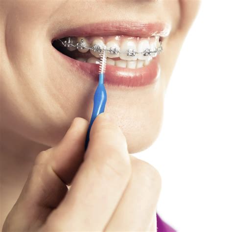 how to remove braces wire at home - Wiring Work