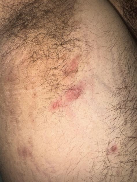Continue to get these bumps on armpits and groin area : r/DermatologyQuestions
