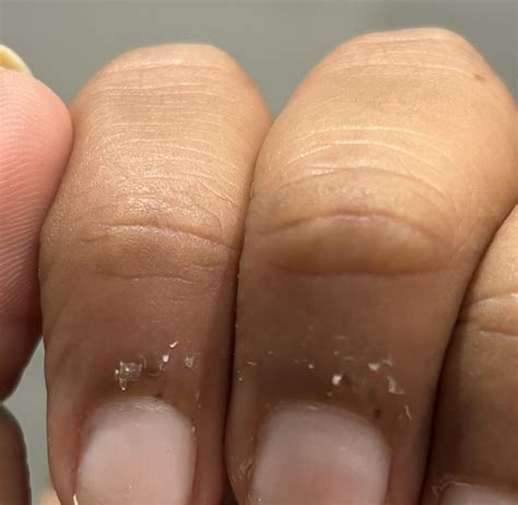 How do you deal with dry skin around nails? : r/AusSkincare
