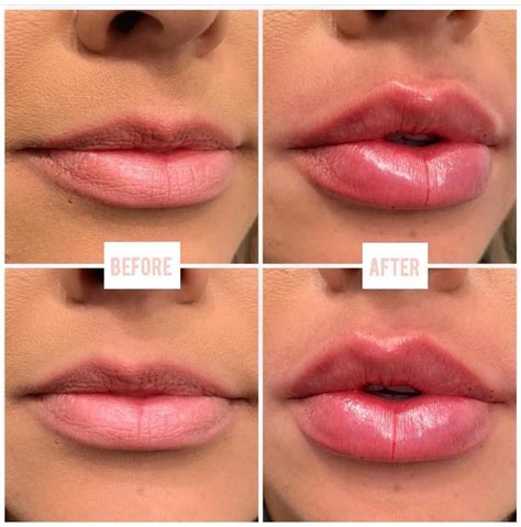 Lip Injection Filler