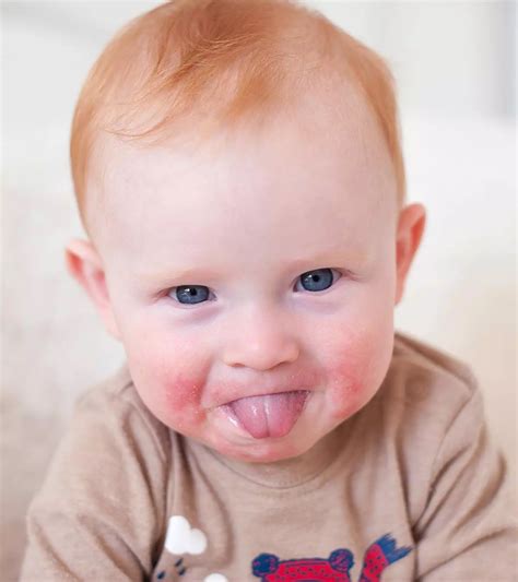 Baby's Chapped Lips: Causes, Home Remedies And Prevention