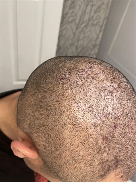 Gram Negative Folliculitis : r/Folliculitis