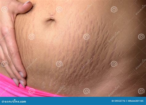Woman Displaying Stretch Marks after Pregnancy Stock Photo - Image of ...