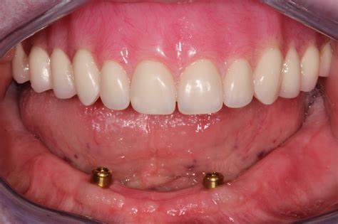 Complete Denture With Implants at Greg Howell blog