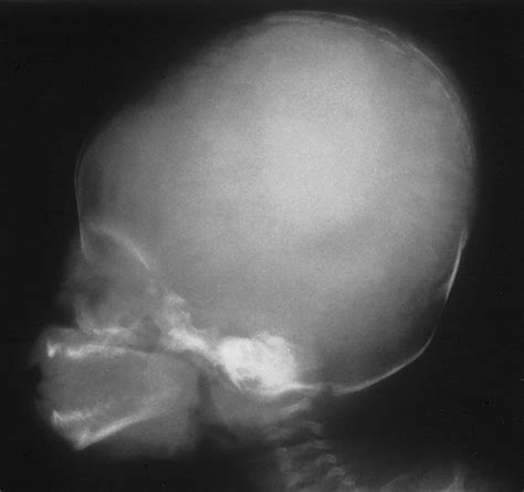 The Infant Skull: A Vault of Information | RadioGraphics