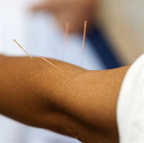 Dry Needling Physical Therapy | Lonoke Physical Therapy & ProMotion Physical Therapy