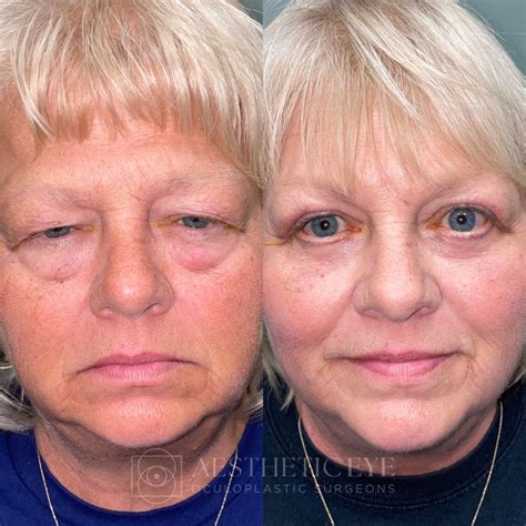 Brow Lift Surgery Archives | AestheticEye