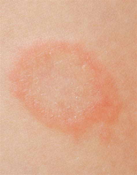 Yeast Rash Under Arms