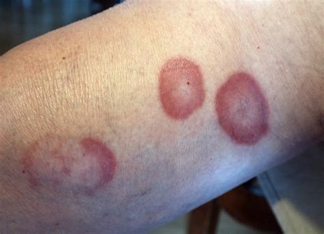 Granuloma Annulare: Understanding the Skin Condition