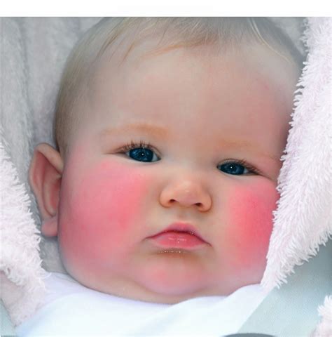 What Causes Rosy Cheeks In A Toddler at Billy Tate blog