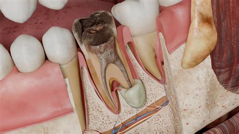 Absceso apical - Causas, síntomas y métodos de tratamiento