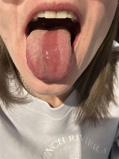 Dulled Taste Buds Tongue