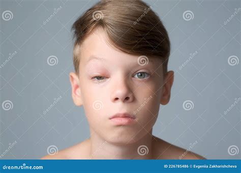 Portrait of Boy with a Swollen Eye from an Insect Bite. Allergy To ...