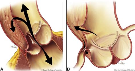 Overview of contemporary guidelines for management of acute type A aortic dissection - The ...