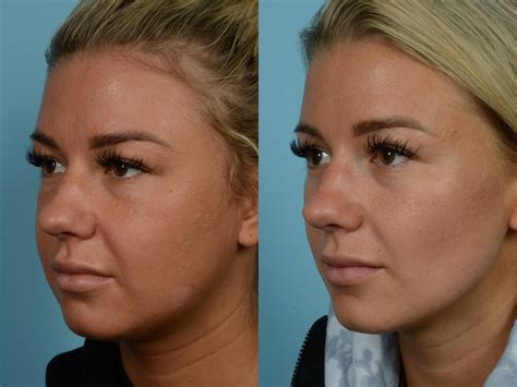 Buccal Fat Removal Jordan at Clinton Spears blog
