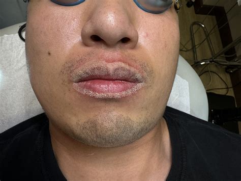 Fordyce Spots: Causes, Symptoms & Effective Treatments - Irvine Skin Clinic