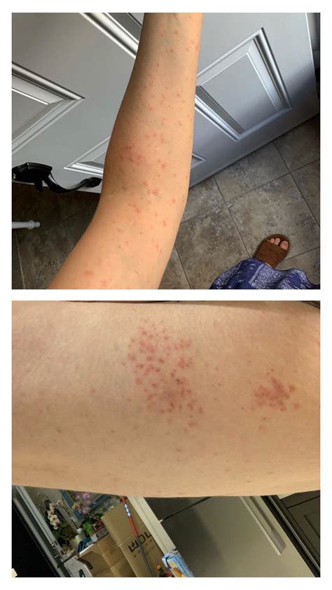 Allergic Reaction Laundry Detergent Rash Pictures at Liam Threlfall blog