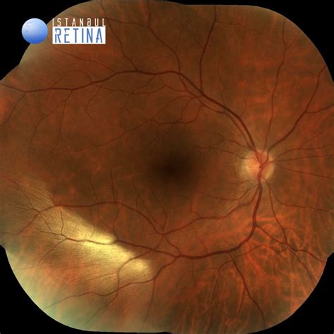56. Myelinated Retinal Nerve Fiber Layer | OCT Club - layers of nerve fibre
