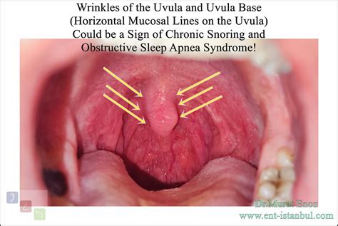 Your "Uvula" Can Tell You a Lot About Whether You Have Snoring and ...