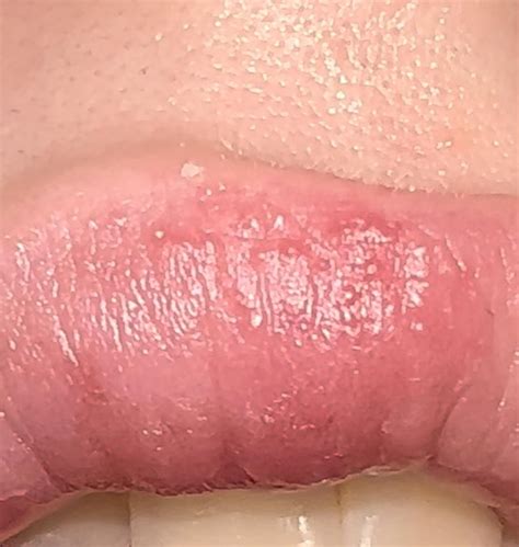 Small red lumps on top lip. Any ideas as to what it is? More info in ...
